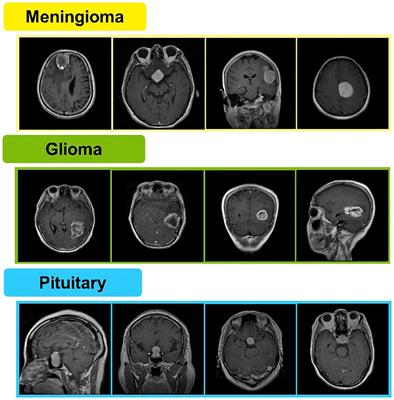 Brain tumor classification from MRI scans: a framework of hybrid deep learning model with Bayesian optimization and quantum theory-based marine predator algorithm